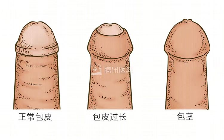 割包皮真的能让时间更持久、更爽，鸡鸡变长吗2