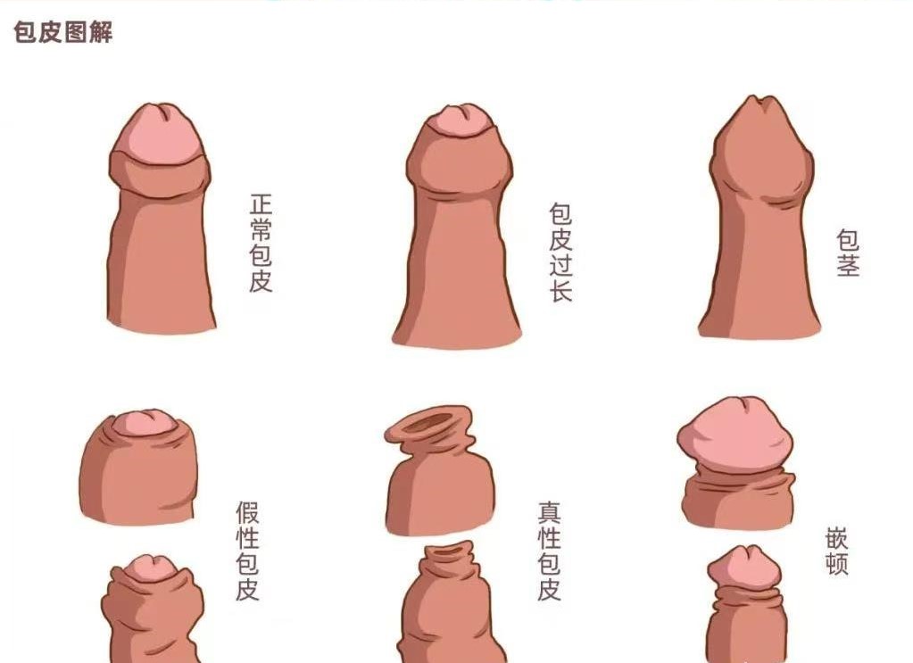 割包皮真的能让时间更持久、更爽,鸡鸡变长吗